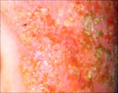 Skin Allergy